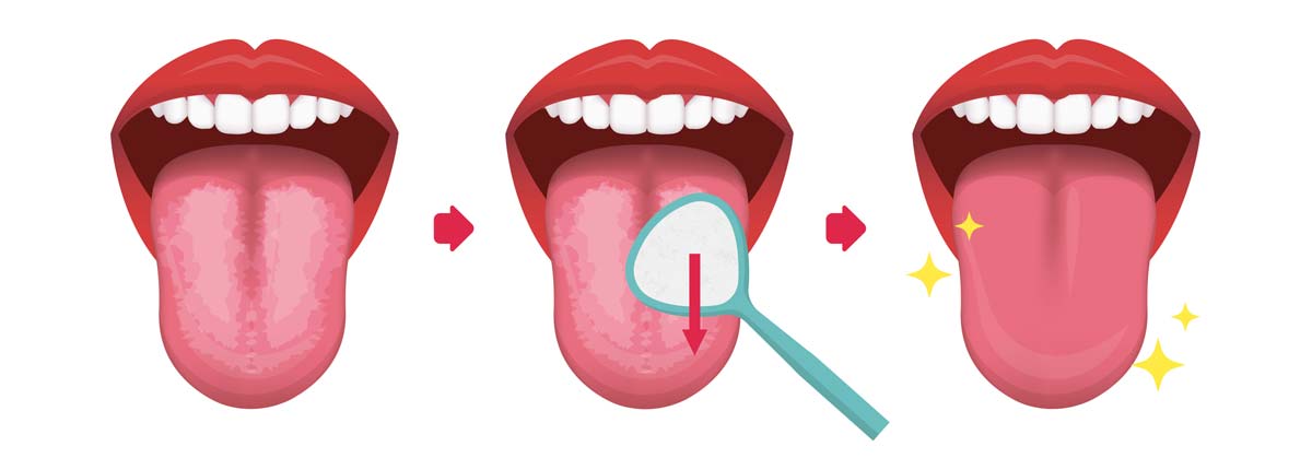 Ablauf einer Zungenreinigung mit dem Zungenreiniger