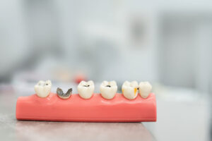 Modell eines Gebisses mit Pulpitis